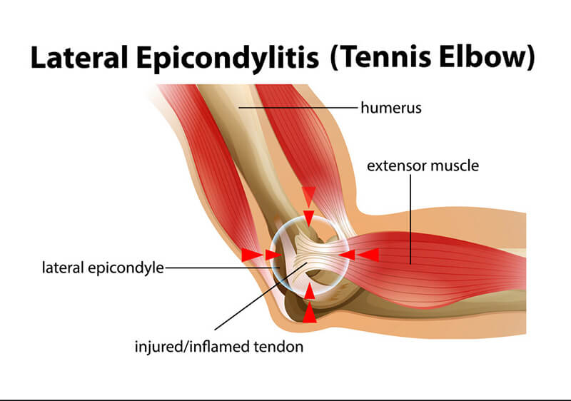 lateral epicondylitis or pickleball elbow